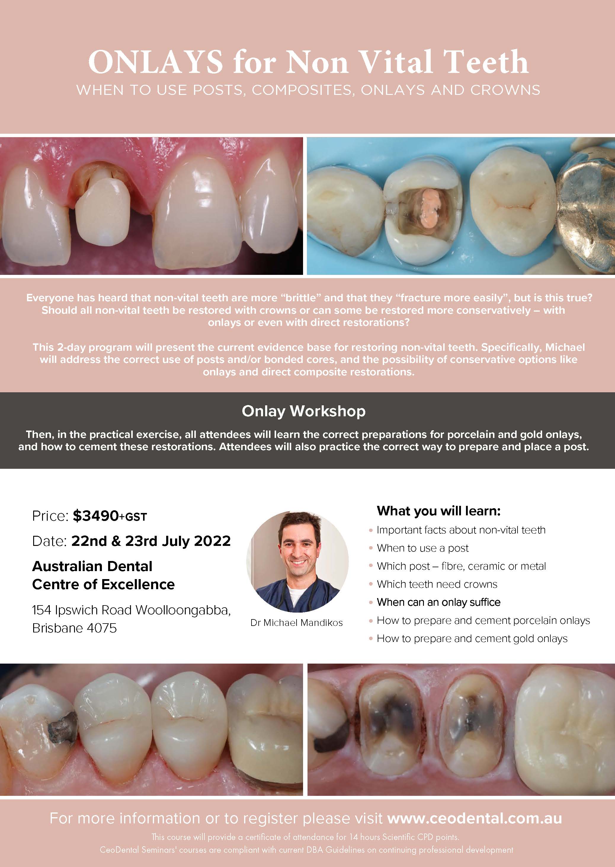 onlays-and-non-vital-teeth-ceodental